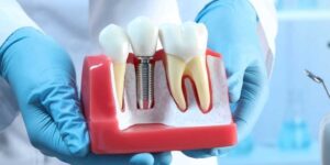 Implant Care Bone Regeneration Supplement for Dental Implants