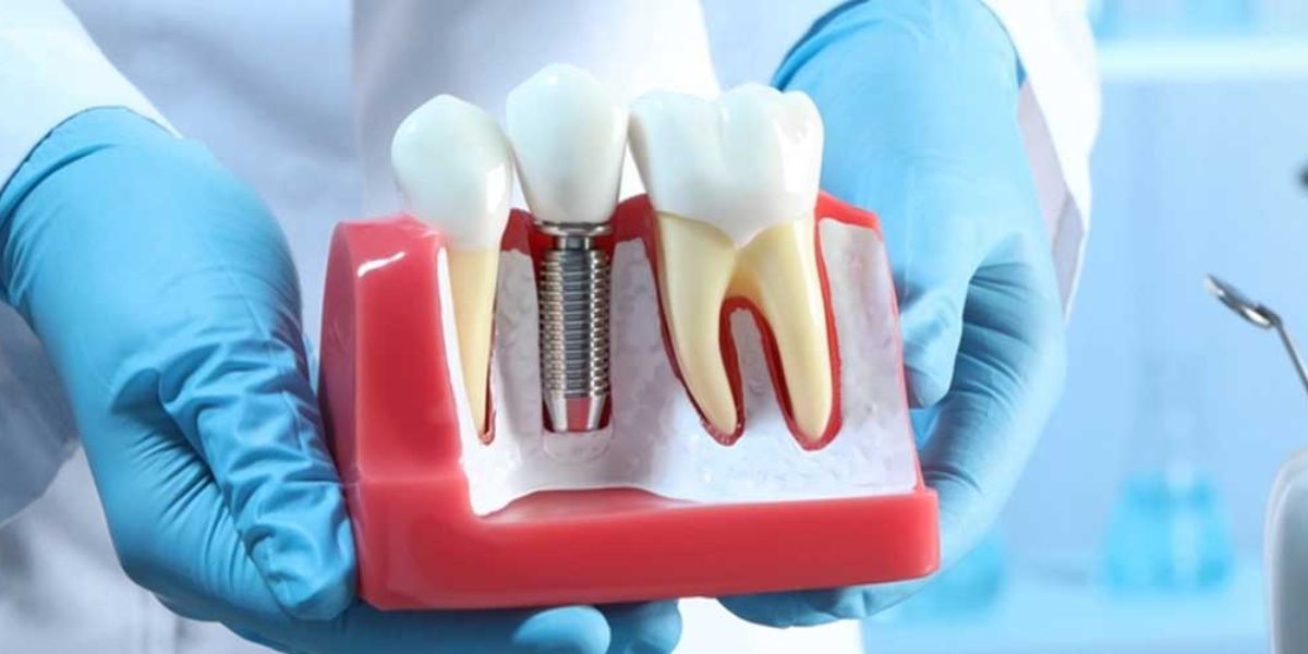 Implant Care Bone Regeneration Supplement for Dental Implants