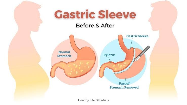 Factors That Affect Gastric Sleeve Cost