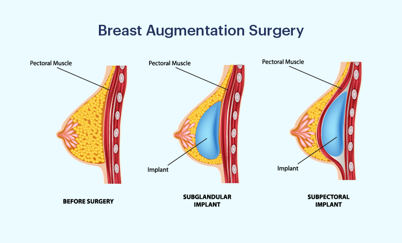 Understand the Total Breast Augmentation Cost